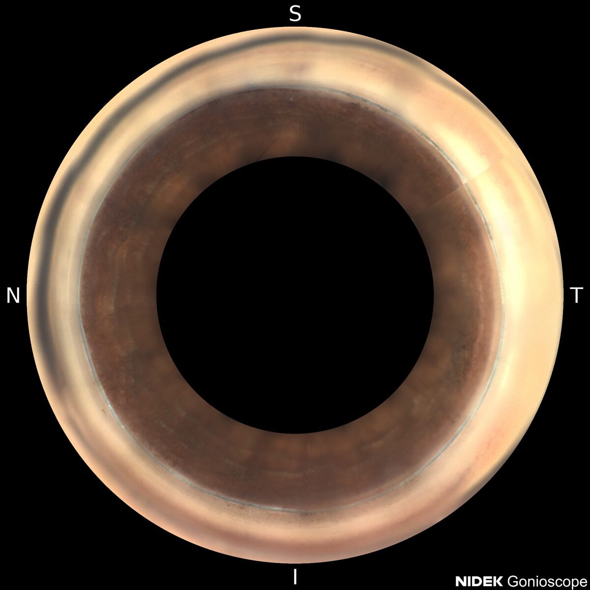 360 Grad Kanaloplastik / Canaloplasty