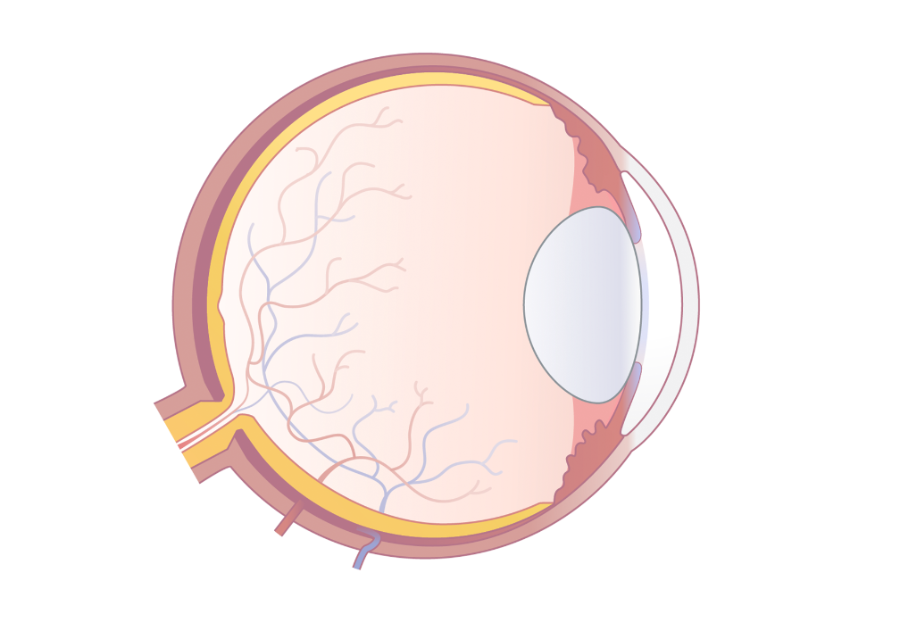 Auge mit grauem Star, mit getrübter und vergrößerter Linse.