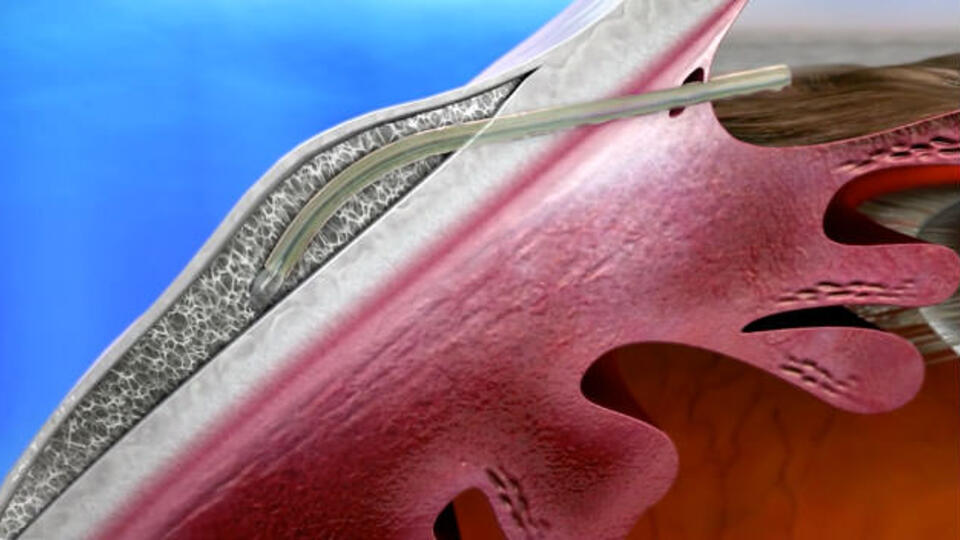 Abbildung eines XEN-Implantats im Auge (Animation)
