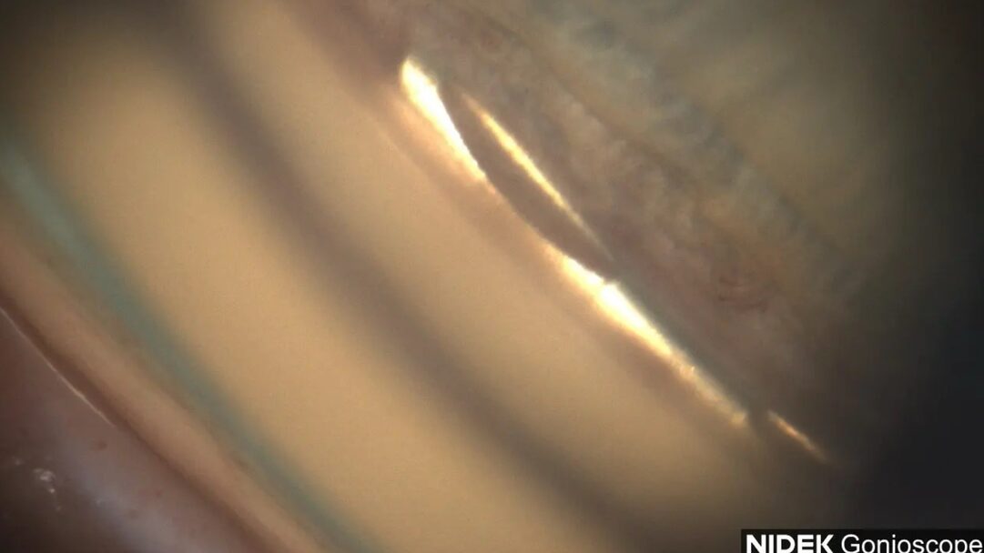 Teil des Kammerwinkels mit sichtbarem Hydrus Microstent.
