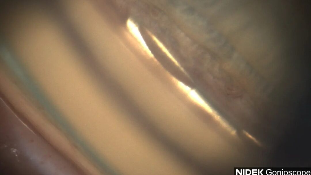 Teil des Kammerwinkels mit sichtbarem Hydrus Microstent.