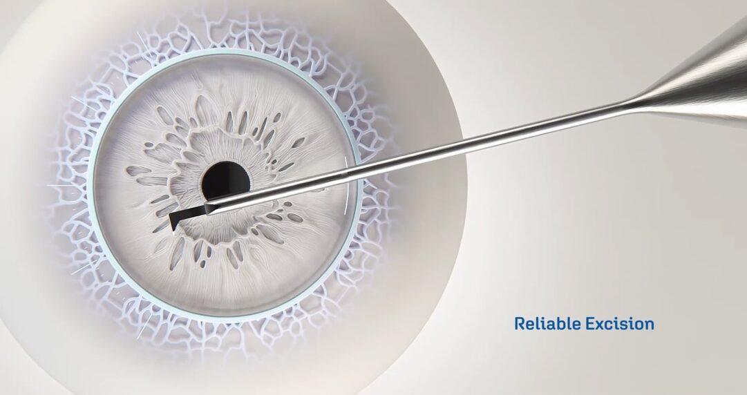 Das Gewebe wird mit dem Instrument aus dem Auge entfernt.