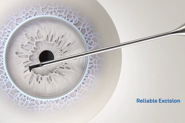 Das Gewebe wird mit dem Instrument aus dem Auge entfernt.