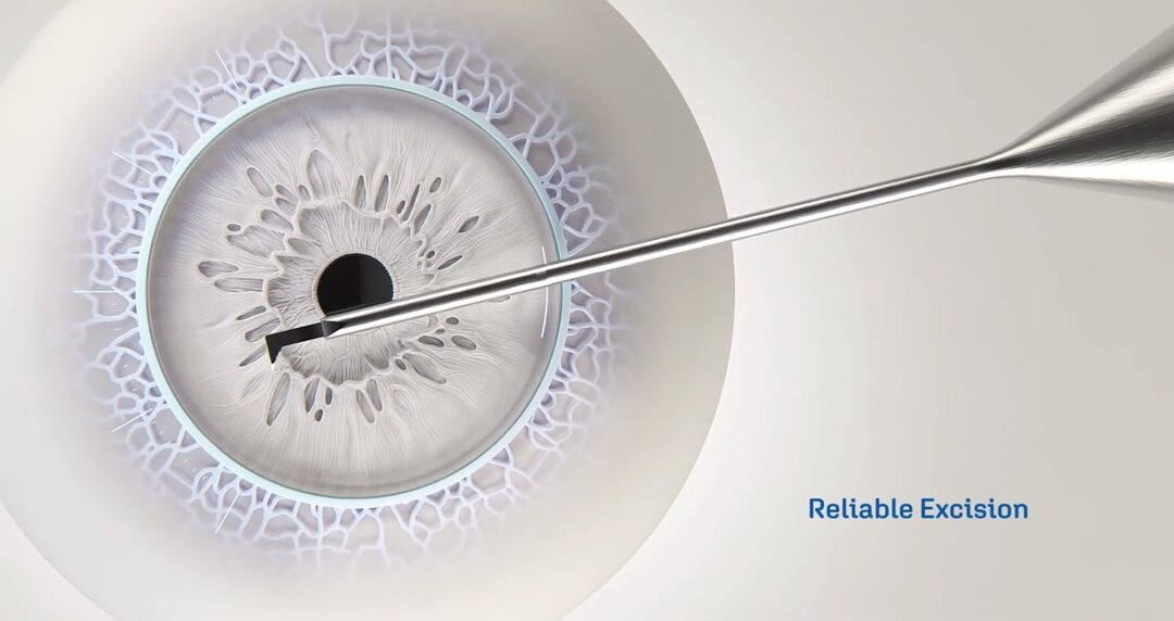 Das Gewebe wird mit dem Instrument aus dem Auge entfernt.