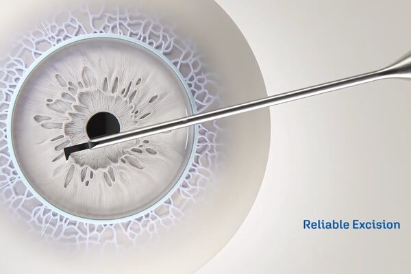 Das Gewebe wird mit dem Instrument aus dem Auge entfernt.