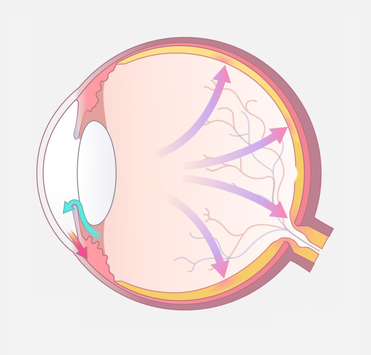 Augenillustration mit Darstellung eines erhöhten Abflusswiderstandes im Auge.