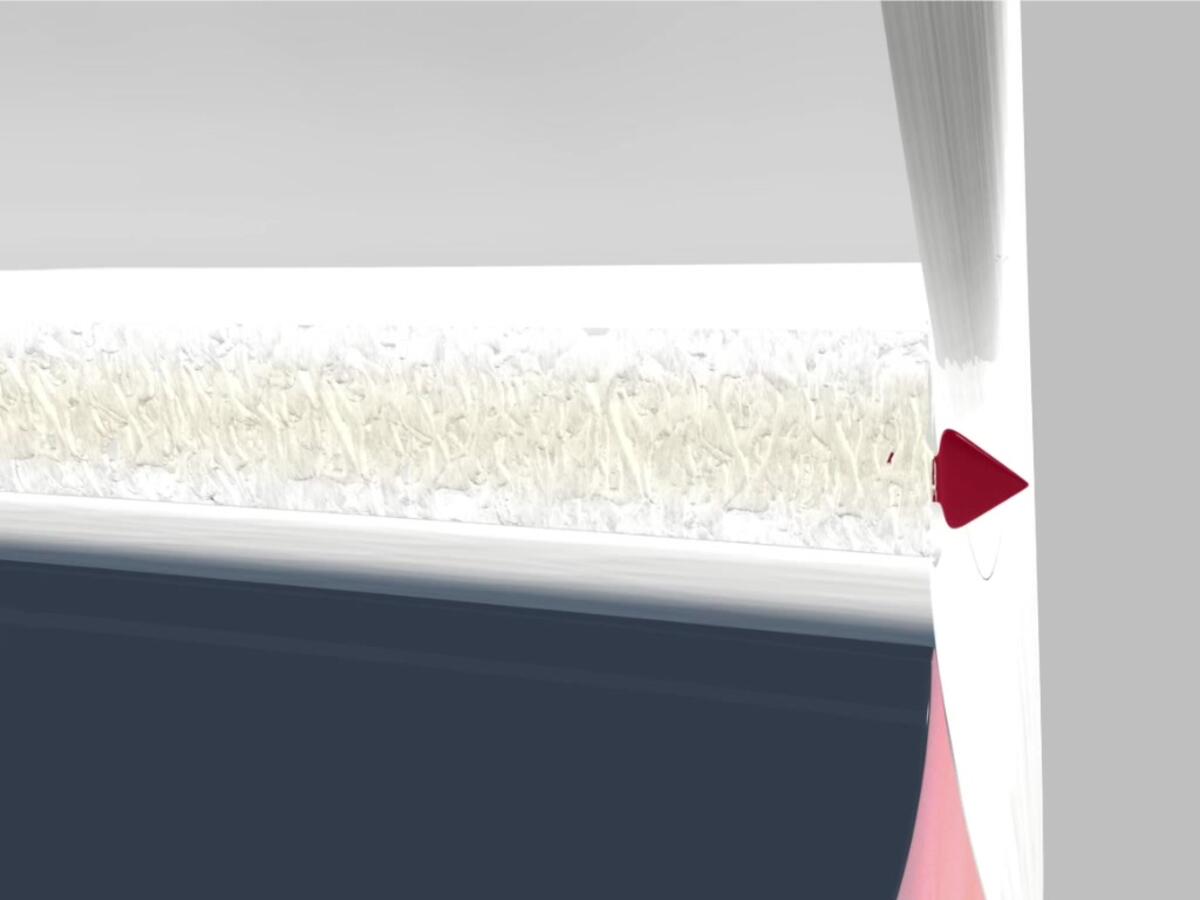 Offenwinkelglaukom Thumbnail